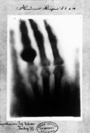 first X-ray photograph of a human body-part